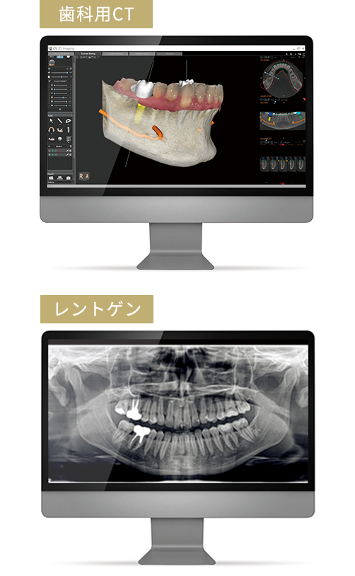 レントゲンとCTの比較画像